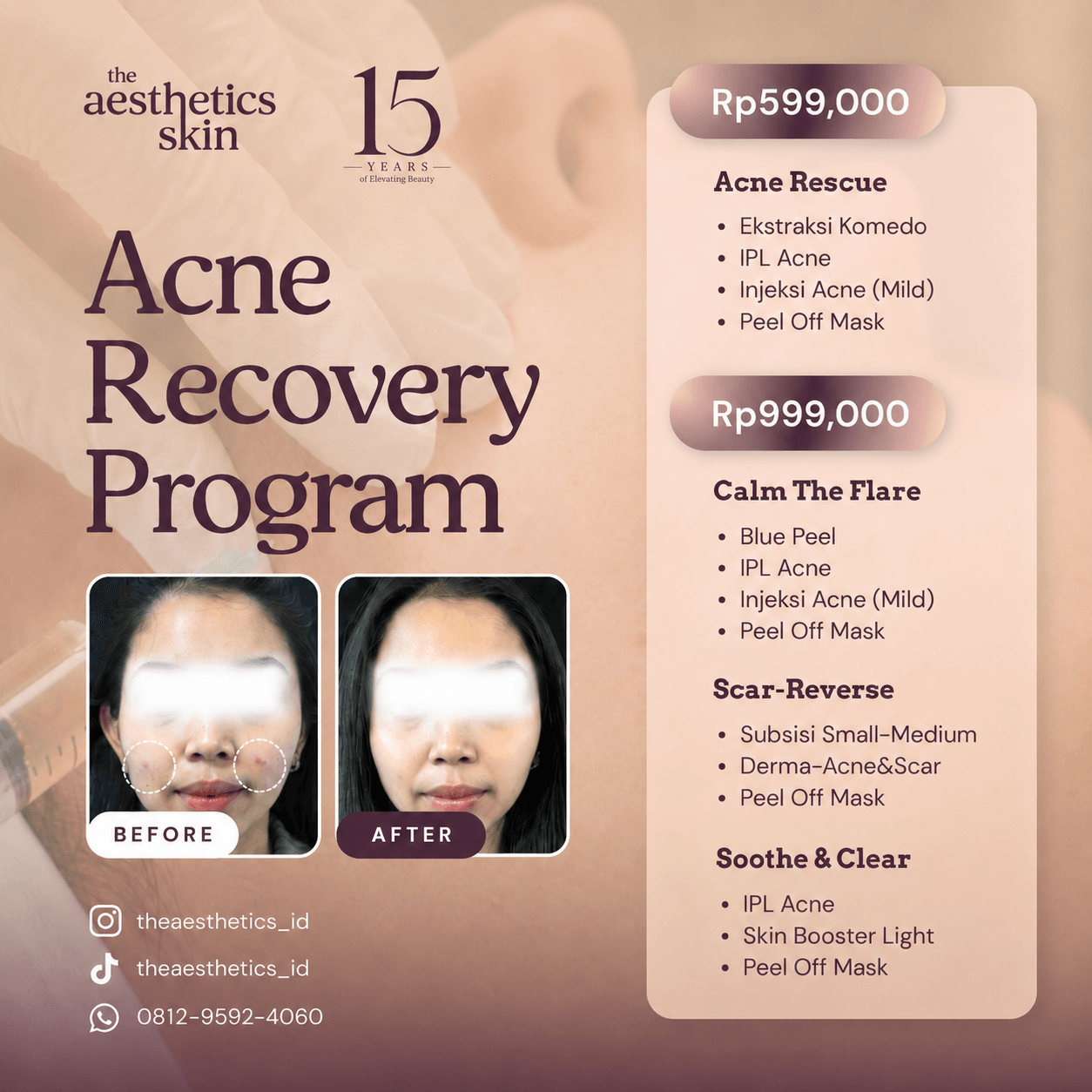 Acne Recovery Program The Aesthetics Skin